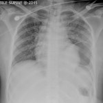 Case of the Month: High Speed MVA