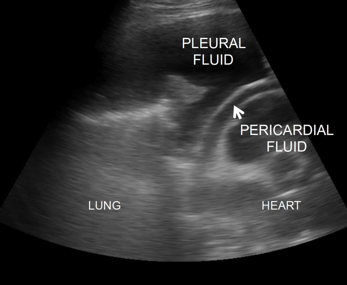 Coexistent pleural and pericardial effusions