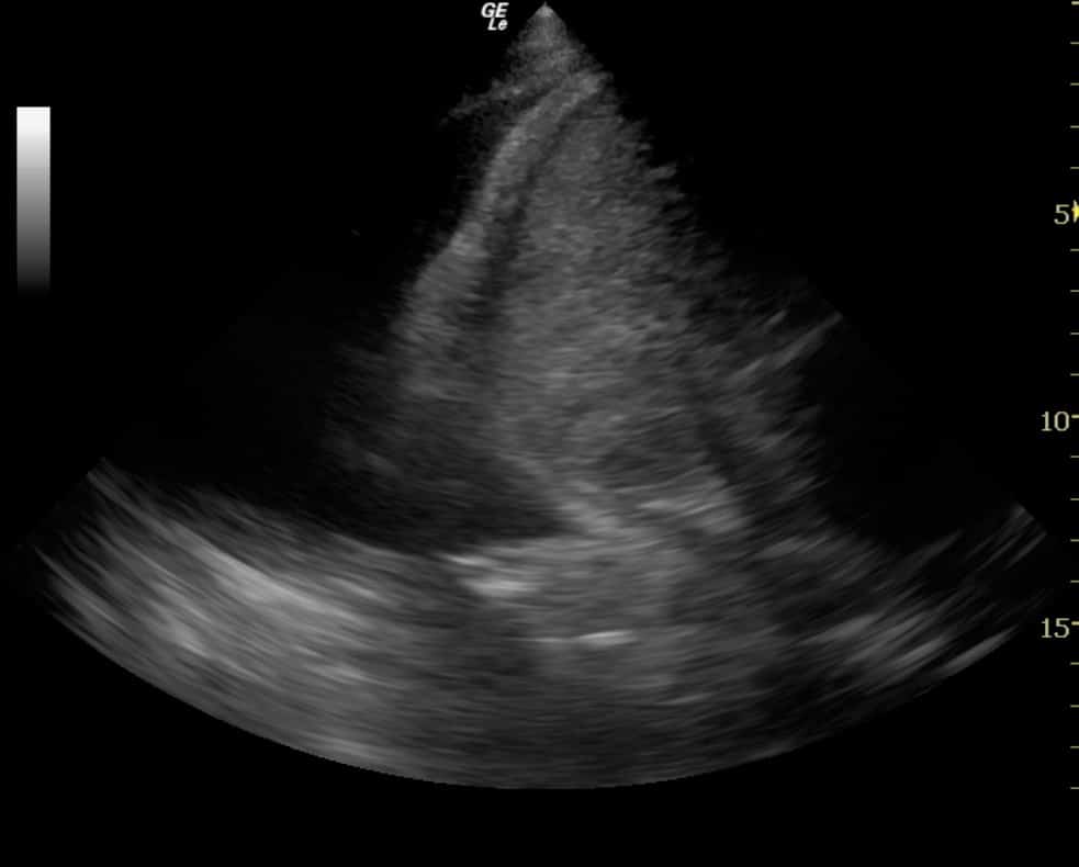 Fig 7. Sector probe RUQ, large pleural effusion (black) above diaphragm