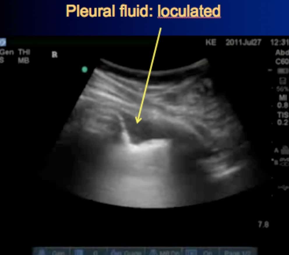 Figure 9: Curved probe, small loculated pleural effusion