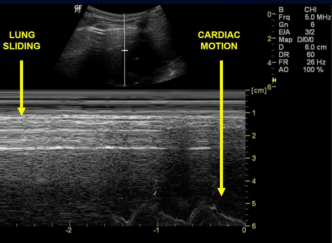 Figure 22 M Mode, lung sliding and cardiac motion
