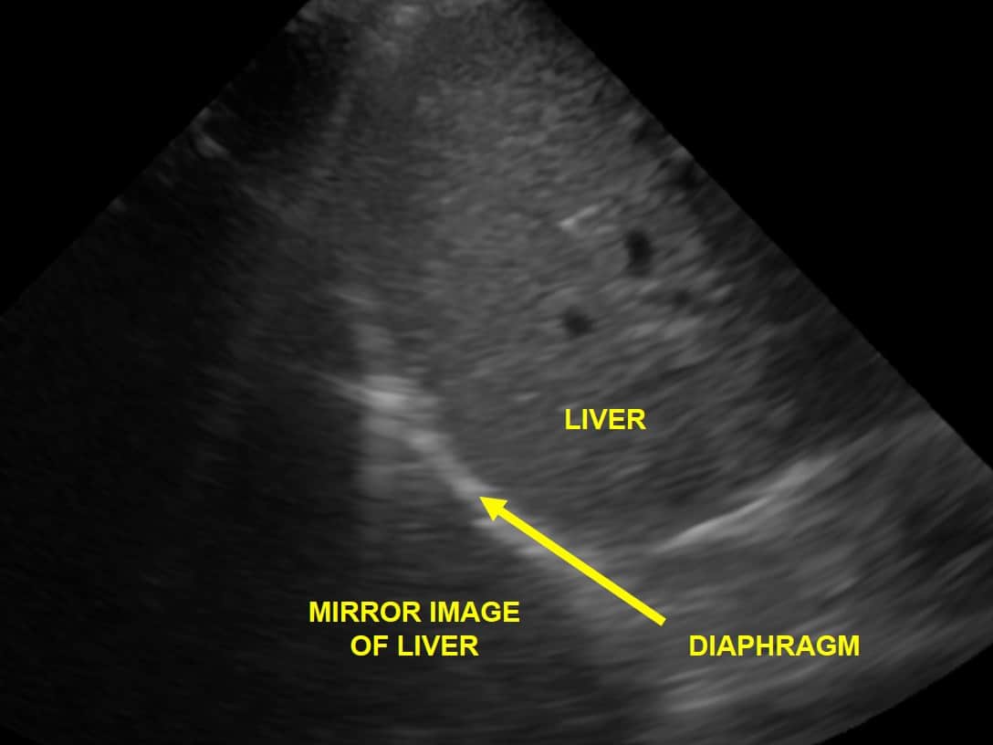 Figure 23 Mirror Artifact: mirror image of liver tissue is seen just above the diaphragm, due to the reflector effect of the air:fluid interface between lung and diaphragm