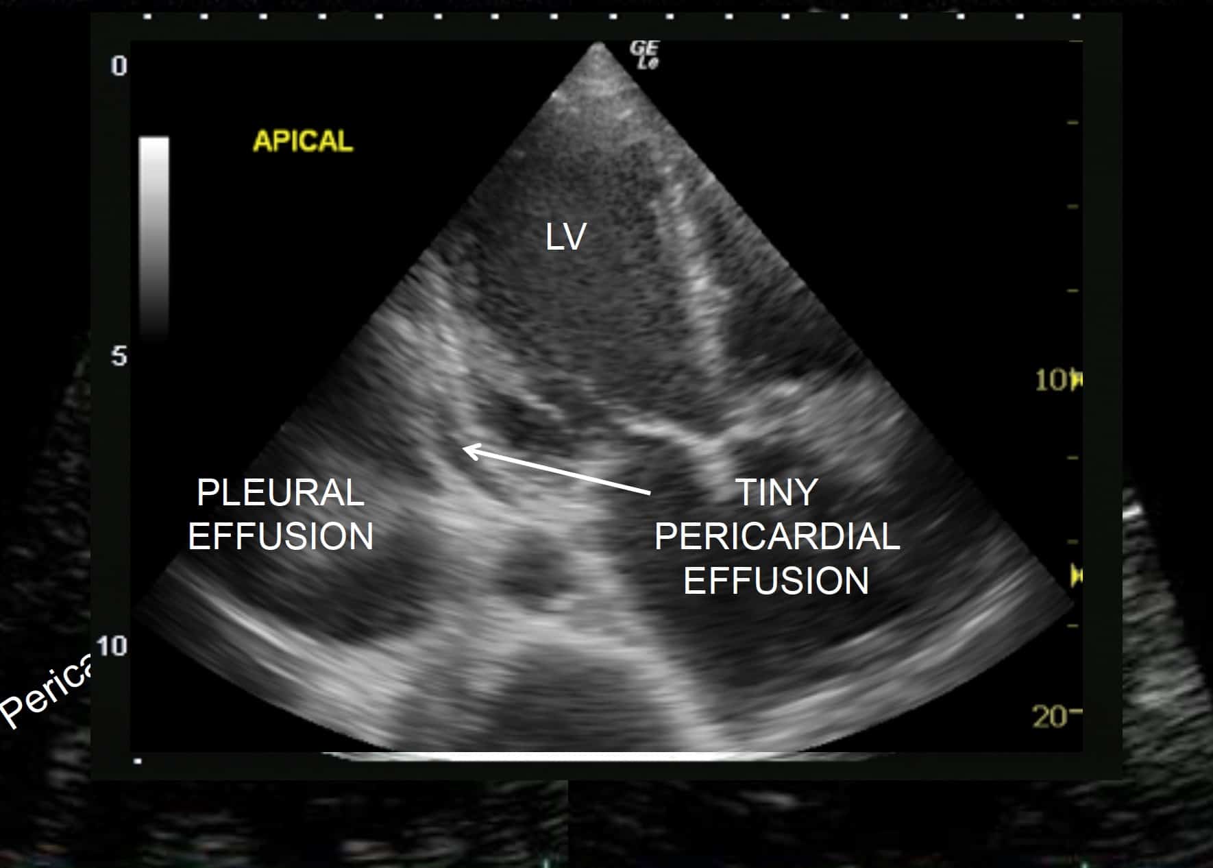 Inverted apical image - tiny pericardial effusion located just in the most dependent part of the pericardial space