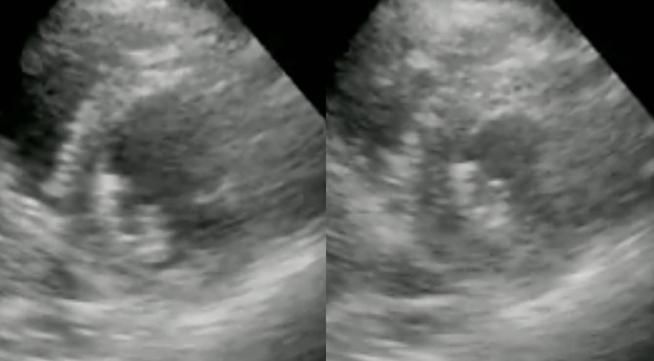 PSAX window - normal LV at papillary muscle level: (a) diastole (b) systole