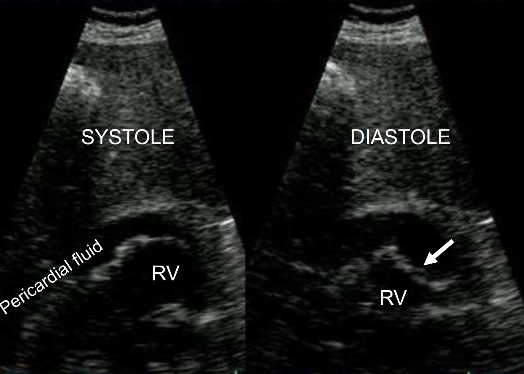 Tamponade - subcostal view - RV collapse in diastole (arrowed)